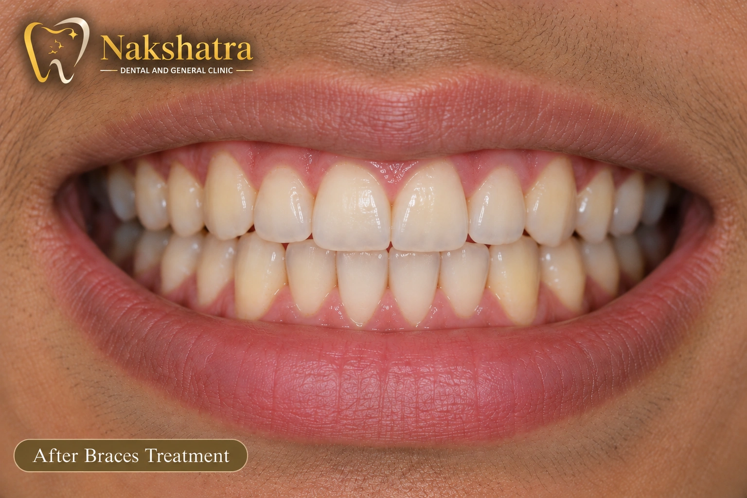 After dental smile transformation, case 3